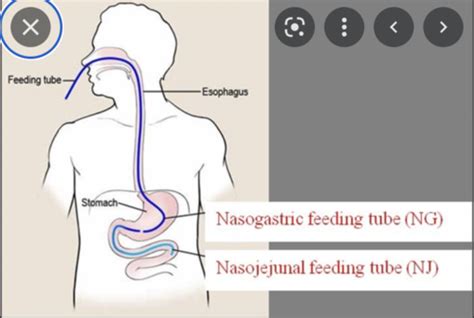 11 Enteral And Parenteral Nutrition Flashcards Quizlet