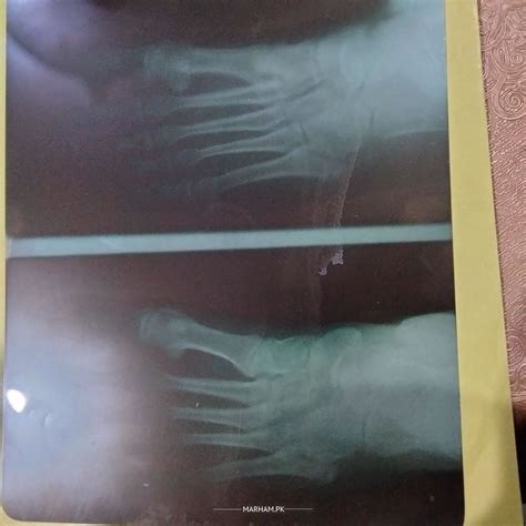 Ask a Cosmetic Surgeon Online for Fracture Of Foot Bone