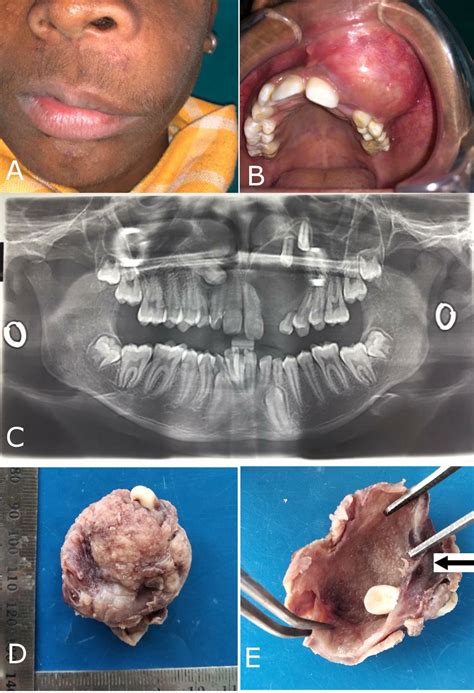 Clear Cell Adenomatoid Odontogenic Tumour And Dentigerous Cyst An