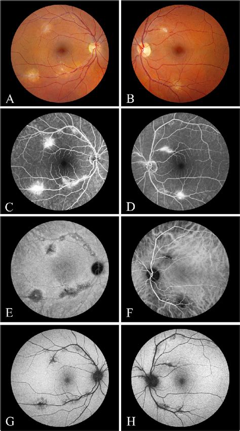 Color Fundus Photographs A And B Fundus Photographs Of The Right A