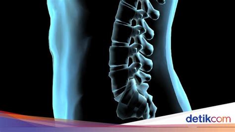 3 Jenis Kelainan Tulang Belakang Skoliosis Kifosis Dan Lordosis