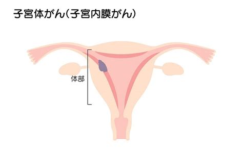 子宮体がん 岡山市の産婦人科は女性医師のいるウィミンズメディカルセンター