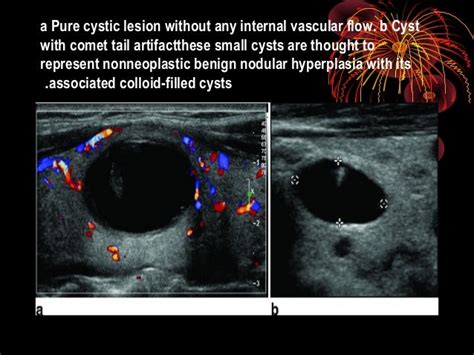 Benign Thyroid Nodule Ultrasound