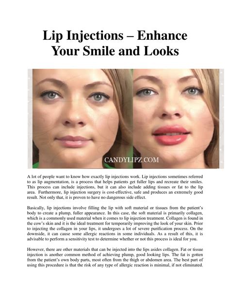 PPT - Lip Injections – Enhance Your Smile and Looks PowerPoint