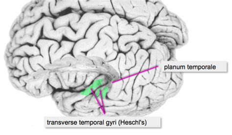 Planum Temporale