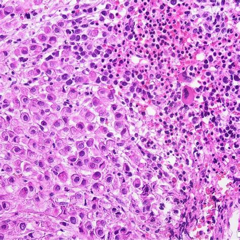 Bone Metastasis Of Lobular Breast Cancer With Erbb2her2 Mutation