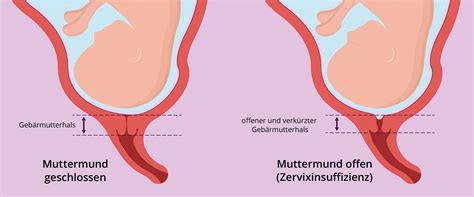 Muttermund Offen Zervixinsuffizienz Ursachen Behandlung