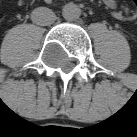 Spinal Schwannoma Radiology Reference Article Radiopaedia Org