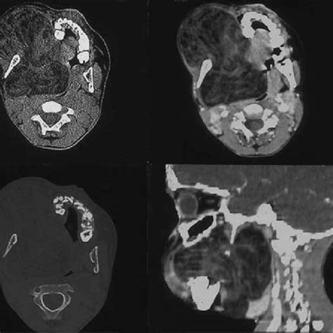 Axial And Reformatted Sagittal Non Contrast And Contrast Enhanced