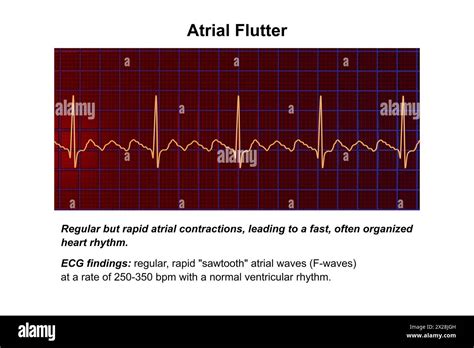 Ecg In Atrial Flutter Illustration Stock Photo Alamy