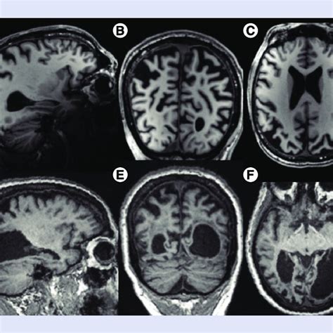 Atrophy Patterns In Posterior Cortical Atrophy The PCA Patient In The