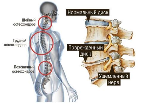 Симптомы и признаки остеохондроза | Клиника доктора Шишонина