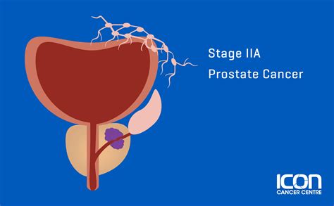 Prostate Cancer Types Signs Symptoms And Stages