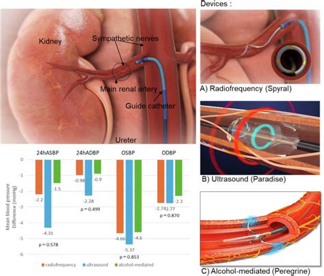 Differences In The Effectiveness And Safety Of Different Renal Denervation Devices