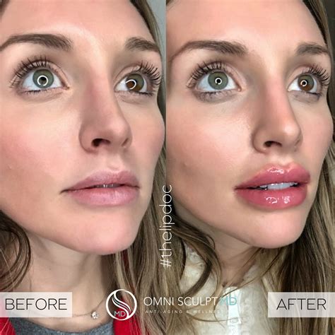 Lip Injection Before After Gallery OMNI SCULPT MD