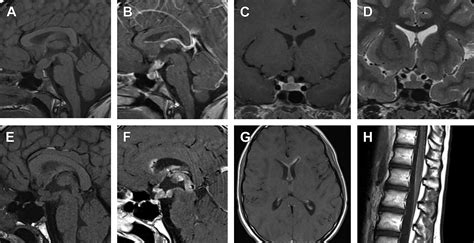 Imaging Of The Sella And Parasellar Region In The Pediatric Population