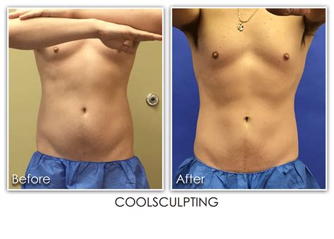 Coolsculpting Pro For Men Archives Skin Rejuvenation Clinic Skin