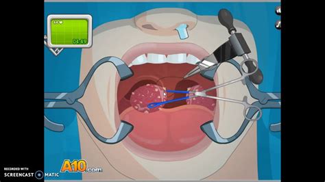 OPERATE NOW TONSIL SURGERY YouTube