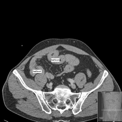 Ct Scan Showing Caecum On The Left Side Of The Abdomen And Terminal