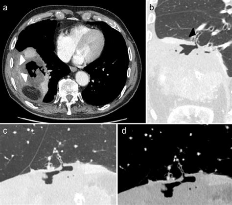 The Axial Cect Image Of The Thorax And Abdomen Demonstrates The