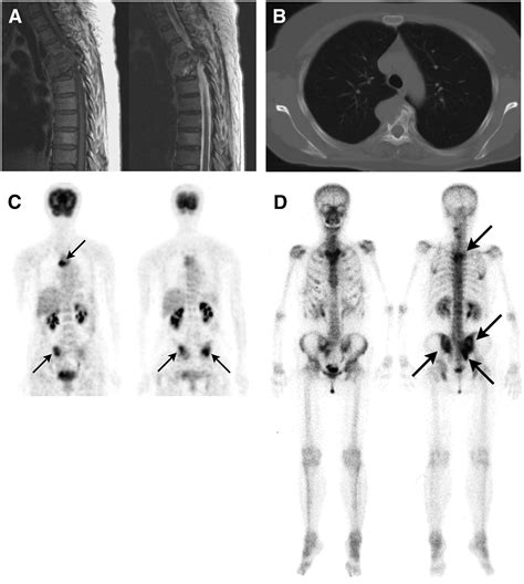 Comparison Of 18F FDG PET And Bone Scintigraphy In Detection Of Bone