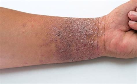 Fotos de dermatite atópica bebês crianças e adultos