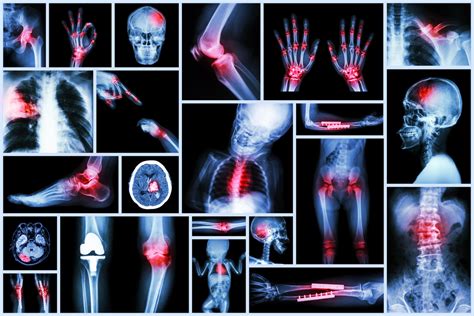 Broke Bones And Types Of Fractures From Car Accidents