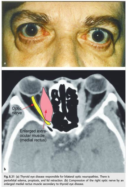 Neuro Ophthalmology Illustrated Chapter 8 Optic Neuropathies 8