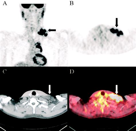 Supraclavicular Lymph Nodes Ct Imaging Of Head And Neck Lymph Nodes