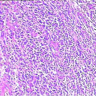 The Hematoxylin And Eosin HE Stained Section Revealed The Tumor