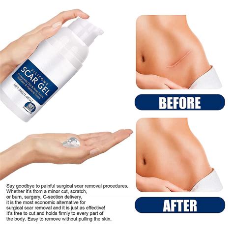 Silicone Scar Gel Ml Scar Cream Advanced Scar Gel For Surgical