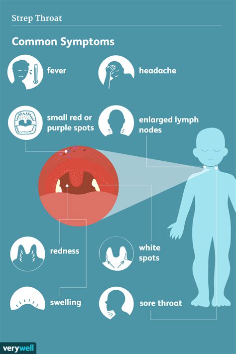 Strep Throat: Symptoms, Signs, and Complications