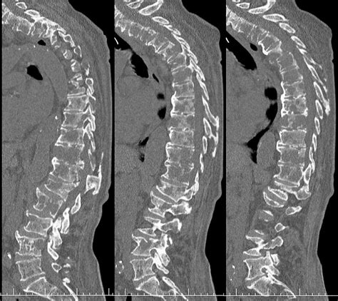 Secondary Spinal Cancer Photograph by Zephyr