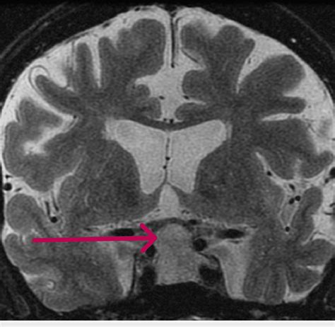 Mri Image Of The Pituitary Gland The Arrow Shows A Large Pituitary