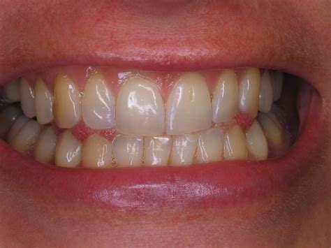 teeth whitening and thin enamel