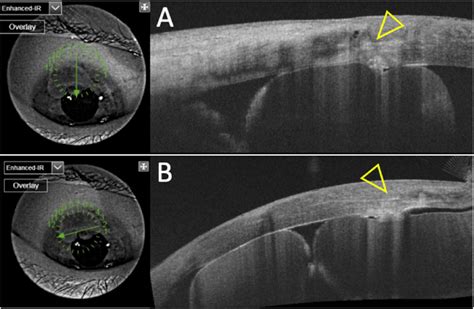 Anterior Segment Optical Coherence Tomography Showing Round Shaped