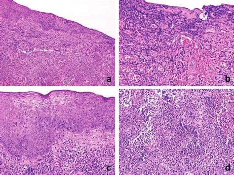 In The Soft Tissue Samples Taken From Around The Tooth Socket Erosion Download Scientific