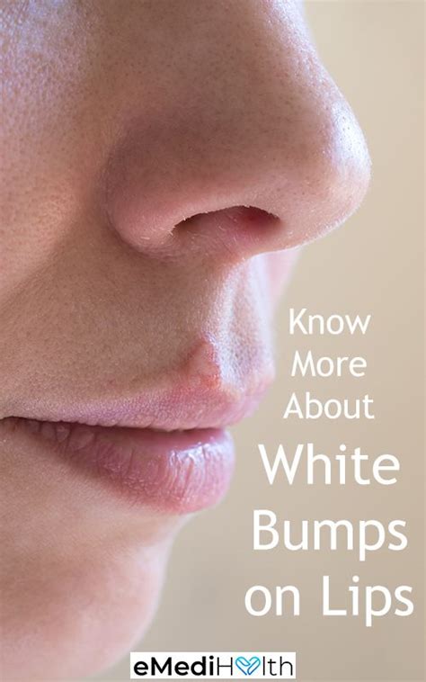 What Causes White Bumps on Lips and How to Treat It? | Lips, Fordyce, Bump