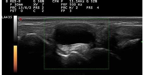 Ganglion Cyst On Wrist Ultrasound