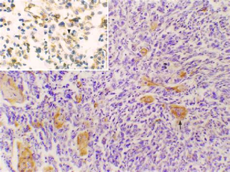 Spindle Cell Carcinoma Showing Cytokeratin Positive Squamous Area