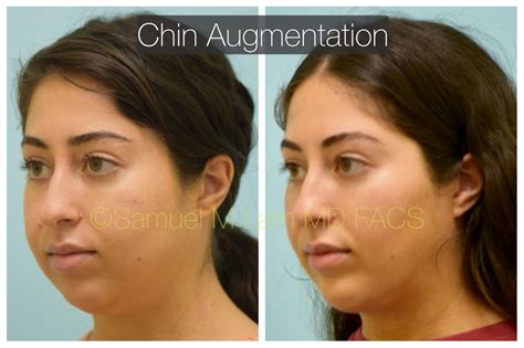 Female Chin Implant Before And After