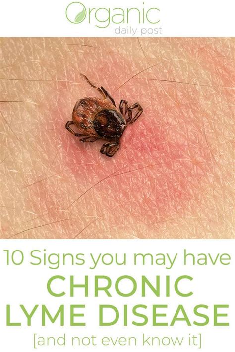 10 Signs You May Have Chronic Lyme Diseaseand Not Even Know It