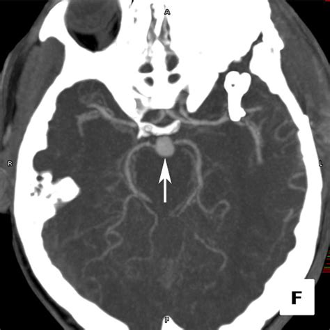 Basilar Artery Aneurysm