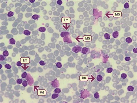 La Leucemia Linfatica Cronica Cll Bald Mountain Science