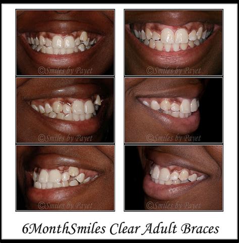 Six Month Braces Charlotte Matthews Lake Norman Dentist