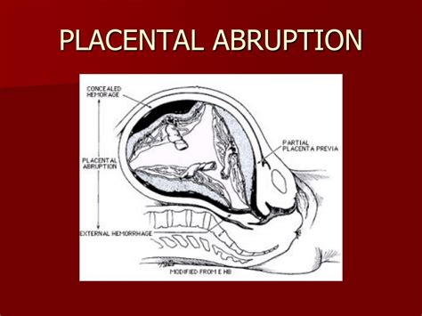 Ppt Placental Abruption Powerpoint Presentation Free Download Id