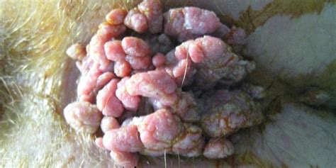 Anal Warts And HPV Virus Colorectal Gr