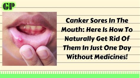 Canker Sores In The Mouth Here Is How To Naturally Get Rid Of Them In