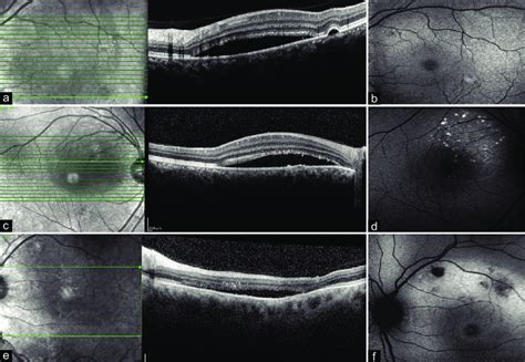 Central Serous Choroidopathy As Related To Macular Degeneration Pictures