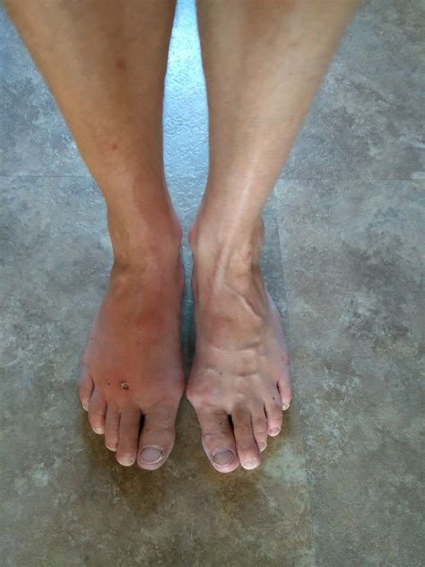 Ignore a painful foot at your peril ! 2nd July 2018 – Hairy Cell Leukaemia